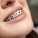 Dental Braces Adelaide